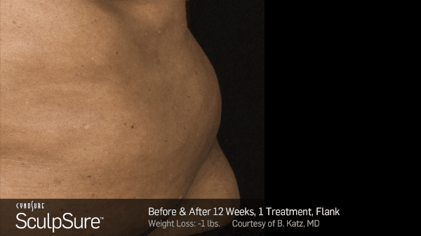 BA-Animated-SculpSure