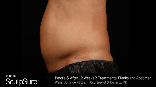 BA-SculpSure
